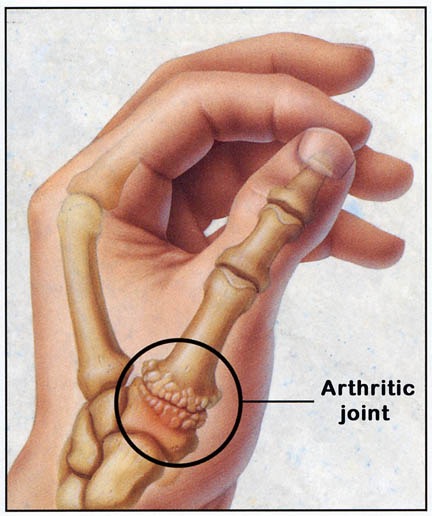 basilar thumb oa