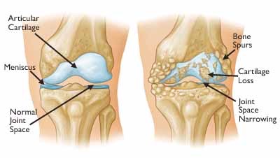 Knee OA - AAOS