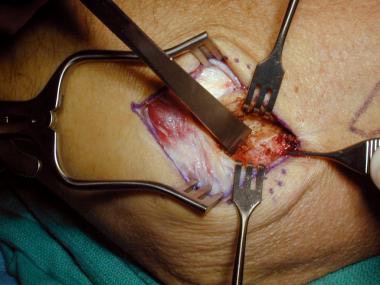 lateral elbow release surgery
