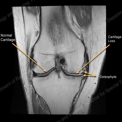 OA NormalCartilage 800x800