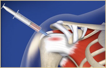 Shoulder PRP